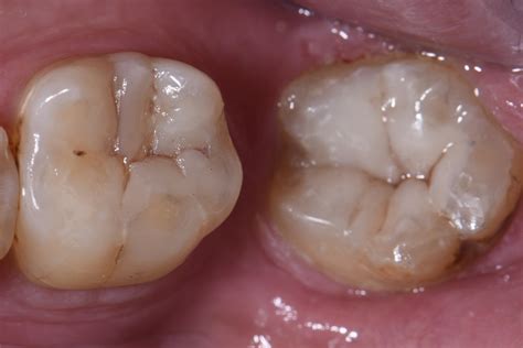 Restoring Angled Wisdom Teeth Cavities