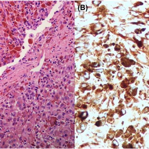 Pathologic examination of the bronchoscopy biopsy specimen (A) Tumor ...