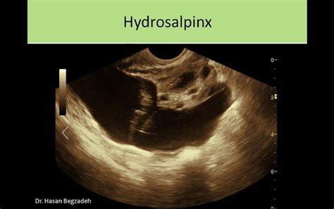 Hydrosalpinx Ultrasound Sonography Sonography Ultrasound