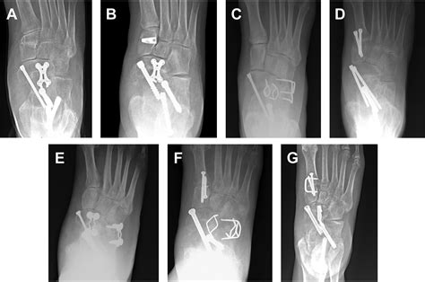 Double Versus Triple Arthrodesis For Flatfoot Deformity Clinics In