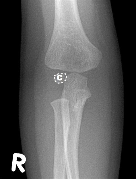 Medial Epicondylar Fractures Pediatric Pediatrics Orthobullets