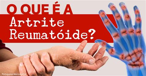 O Que é a Artrite Reumatóide