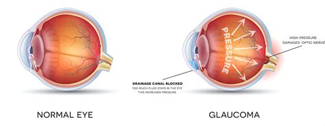 Glaucoma Pasadena | Glaucoma Treatment Alvin | Coastal Eye Associates