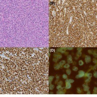 Low Grade Follicular Lymphoma Transforming Into Diffuse Large B Cell