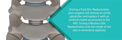 Artificial Disc Replacement A Minimally Invasive Solution Njso