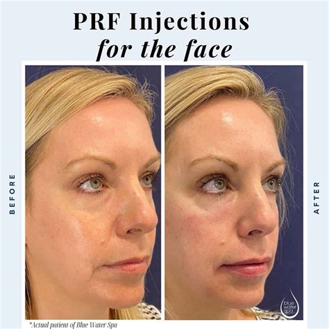 Prf Injections For The Face Ulike Blog