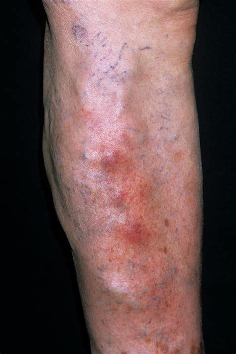 Superficial Venous Thrombosis