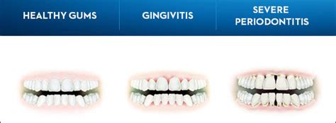 What Is Gingivitis Symptoms Causes And Treatments Crest Ca