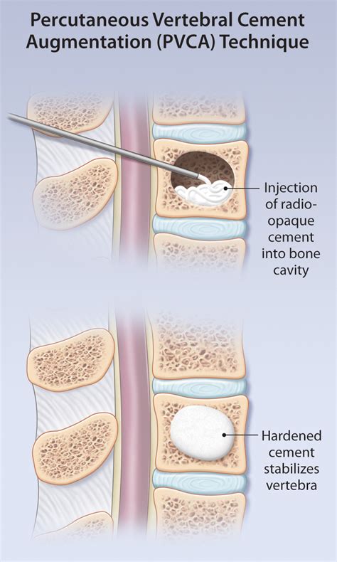 Osteoporotic Vertebral Compression Fractures Diagnosis And Management