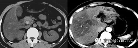 胆总管结石致肝内外胆管扩张及慢性炎症ct病例图片影像诊断分析 Medscicn