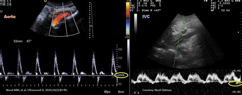 Inferior Vena Cava Pocus The Basics Of Image Acquisition Renal