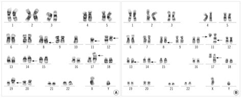 Giemsa Trypsin Banding Showed The Following Karyotypes Download