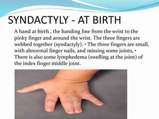 Amniotic Band Syndrom Epptx Ppt