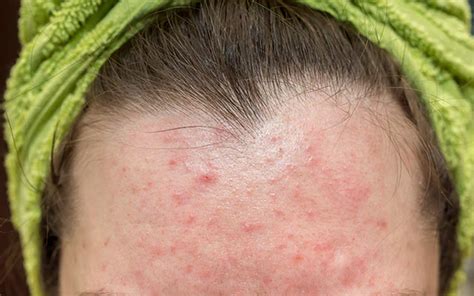 Mengenal Skincare Untuk Fungal Acne Penyebab Hingga Gejala Varia