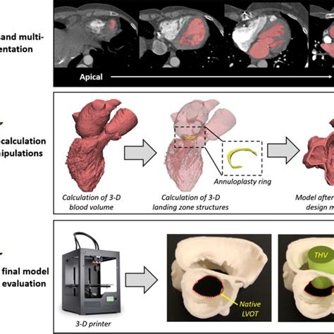 Mitral Annular Segmentation Virtual Device Simulation And Neo LVOT