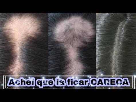 Alopecia Areata Produtos Q Usei Pra RECUPERAR MEU CABELO YouTube