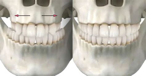 MSE Palate Expander: Face Changes, Before & After