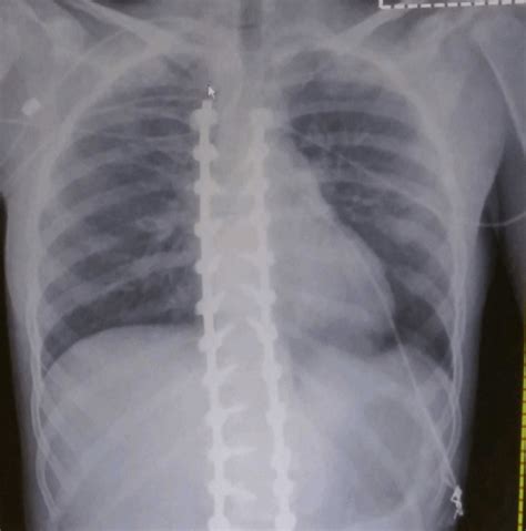 Hardware removal? : r/spinalfusion