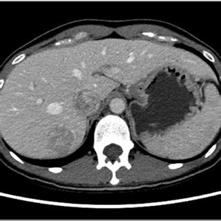 Contrast Enhanced Computed Tomographic Ct Imaging Of A Primary