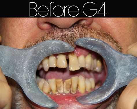 The Golpa (G4)-Implant Solution provides a permanent, titanium re ...