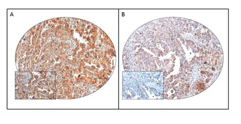 Pd L Immunohistochemical Staining In Endometrial Cancer Tissue