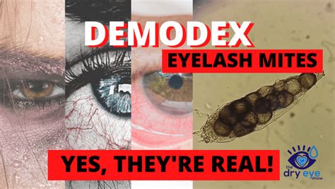 Demodex Eyelash Mites...Yes, They're Real! - Eye Love