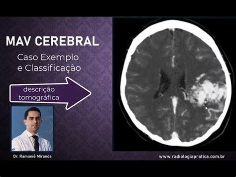 Mav Cerebral Malforma O Arteriovenosa Mav Angiotomografia