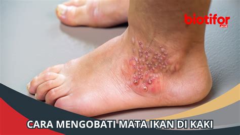 Mata Ikan di Kaki: Penyebab, Pengobatan, dan Pencegahan - Biotifor