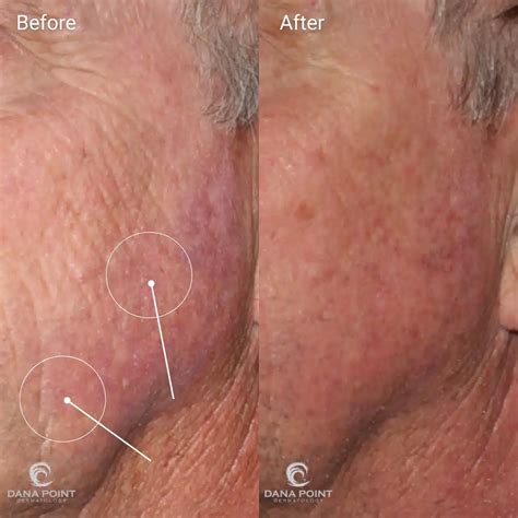 Ablative Fractionated Co2 Laser Resurfacing Men Before And After Dana Point Dermatology