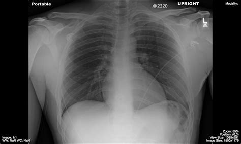 Chest Undergraduate Diagnostic Imaging Fundamentals