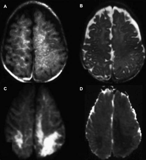 Diffusion Imaging In Traumatic Brain Injury Radiology Key