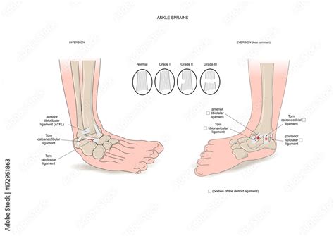 Two common types of ankle sprain (inversion and eversion) Stock Vector | Adobe Stock