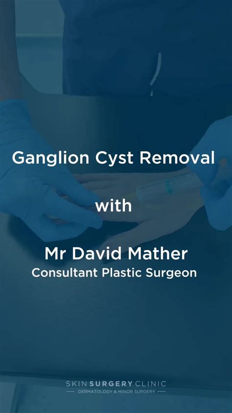 Ganglion Cyst Removal Videos - Treatment - Skin Surgery Clinic