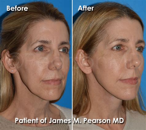 Facelift Photos Before After Dr James Pearson Facial Plastic Surgery