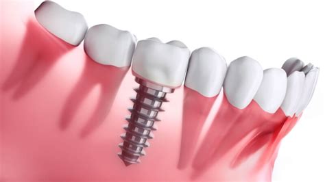 Dental Implants Procedure Explained District Dentistry Charlotte