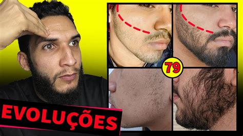 Evolu O Dos Inscritos Minoxidil Antes E Depois Youtube