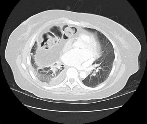 Axial Computed Tomography Scan Of The Chest And Abdomen Demonstrating