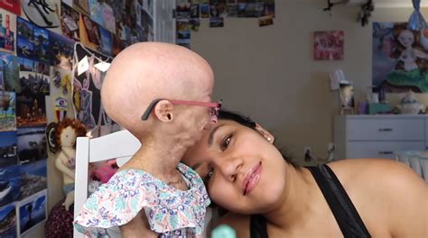 Adalia Rose La Pequeña Youtuber Con Envejecimiento Prematuro Que