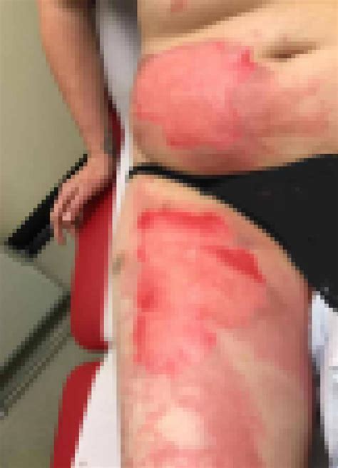 Mum Left With Agonising Burns After Her Hot Water Bottle Burst Open