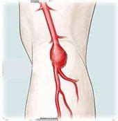 Popliteal Aneurysm in Sector 38 , Gurgaon , Division Of Peripheral ...