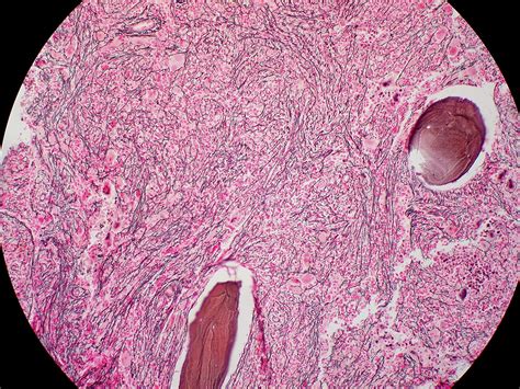 Primary Myelofibrosis | Concise Medical Knowledge