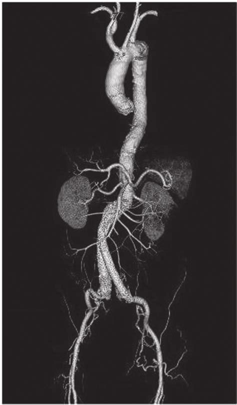 Postoperative 3d Ct Confirmed A Patent Endovascular Graft In A Good Download Scientific Diagram