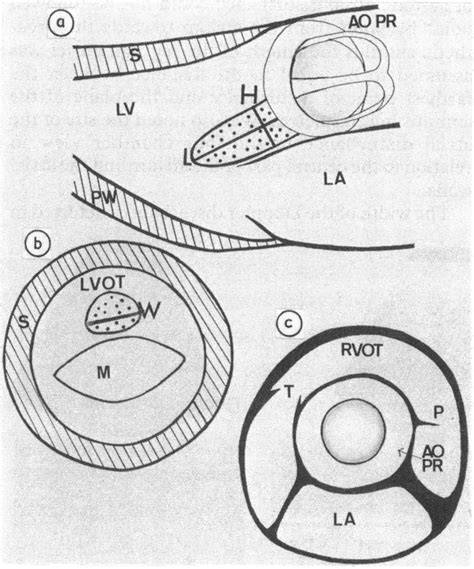 Diagrams Showing The Calculation Of The Left Ventricle Outflow Tract