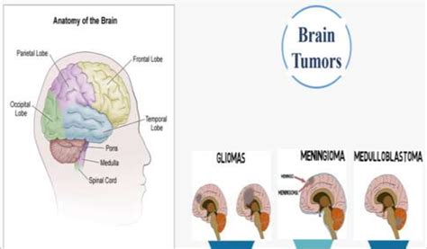figure anatomy   brain  brain tumor types