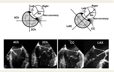 Figure 2 From Accurate Measurement Of Mitral Annular Area By Using