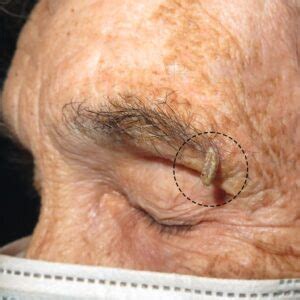 Cutaneous Horn What It Is Why It Forms And How To Treat It