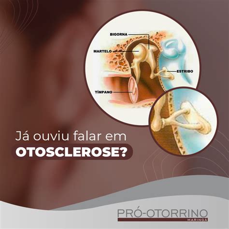 O Que É Otosclerose - Já ouviu falar em Otosclerose? - Pró Otorrino