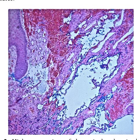 Figure 2 From An Unusual Presentation Of Stewart Treves Syndrome On The