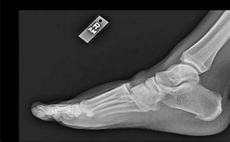 Lisfranc Fracture Dislocation Pre Reduction Radiograph Lateral View Download Scientific