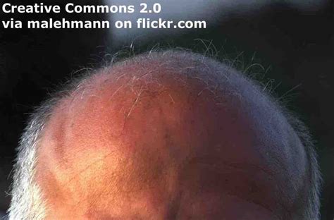 Baldness Esl Lesson Plan Breaking News English Lesson